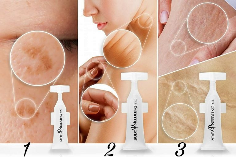 microneedling
