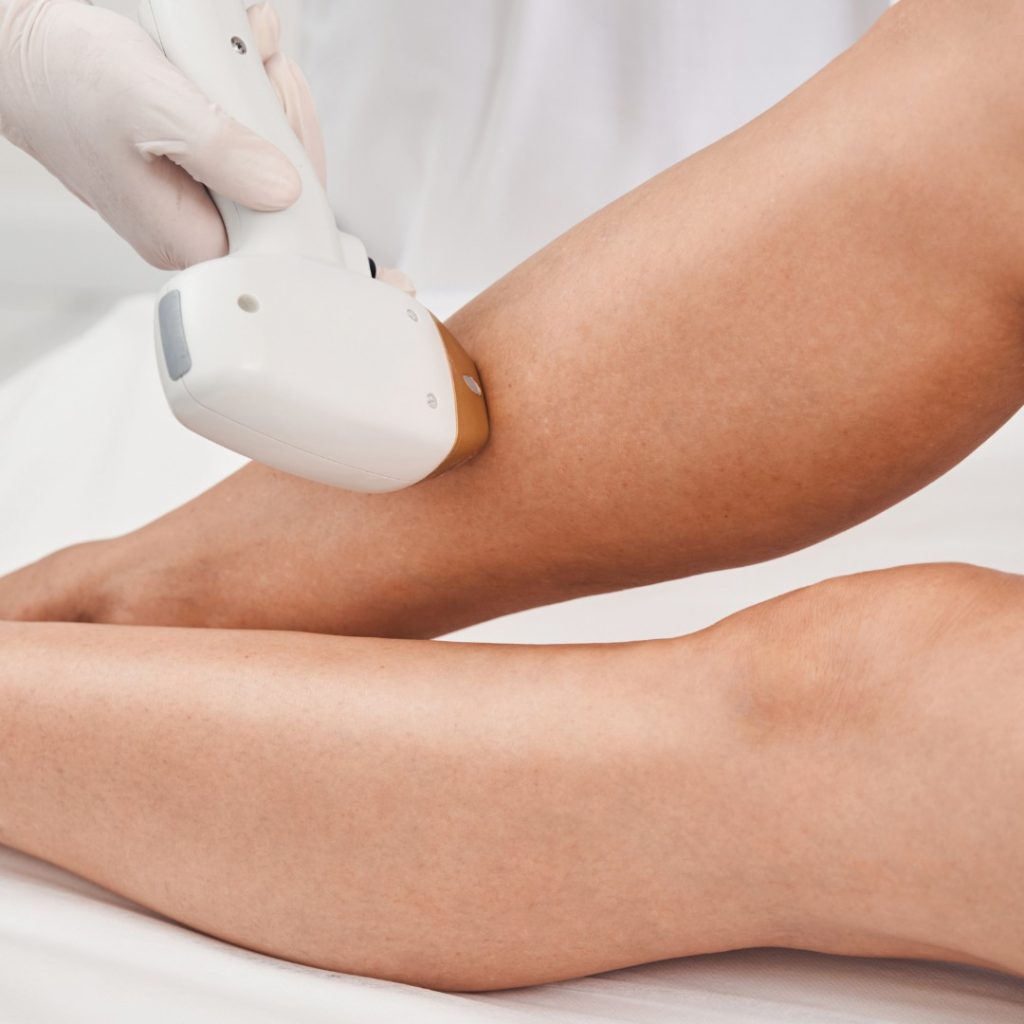 laser hair removal