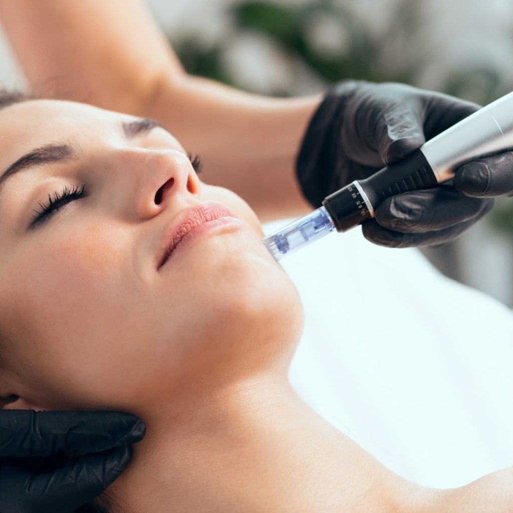 microneedling