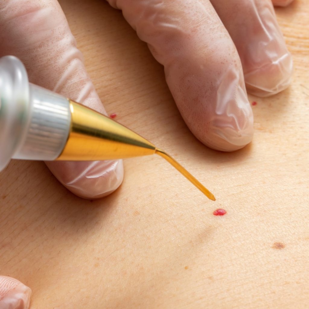 skin tag