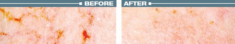 vasculyse avant apres before after telangiectasie telangiectasia