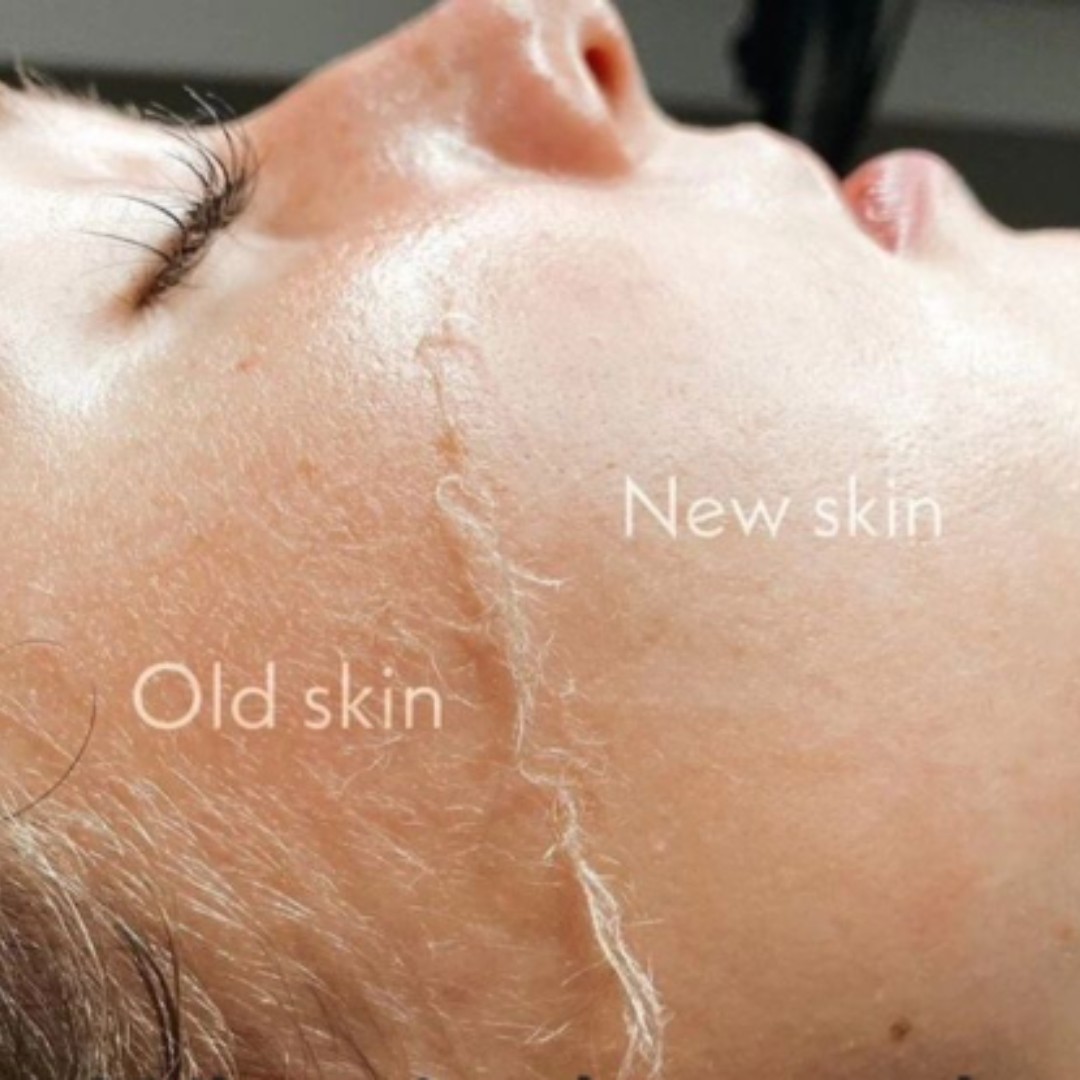 dermaplaning