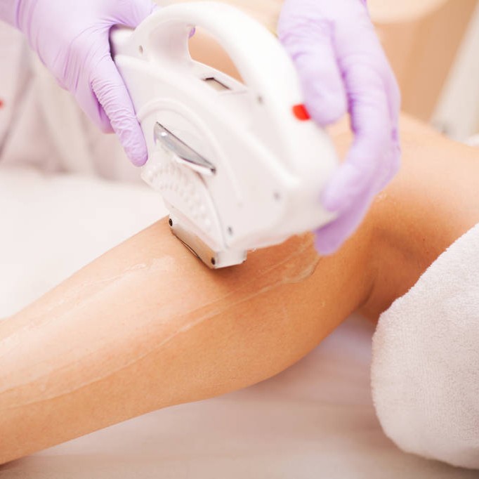 laser hair removal