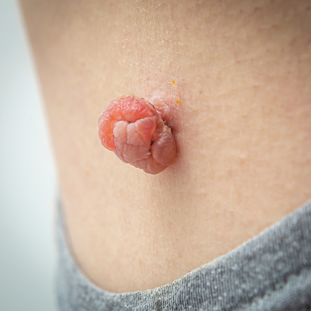 skintag