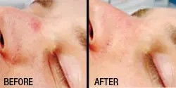 spider angioma